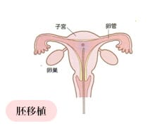 胚移植イメージ