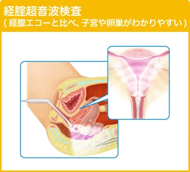 経膣超音波検査（経腹エコーと比べ、子宮や卵巣がわかりやすい）
